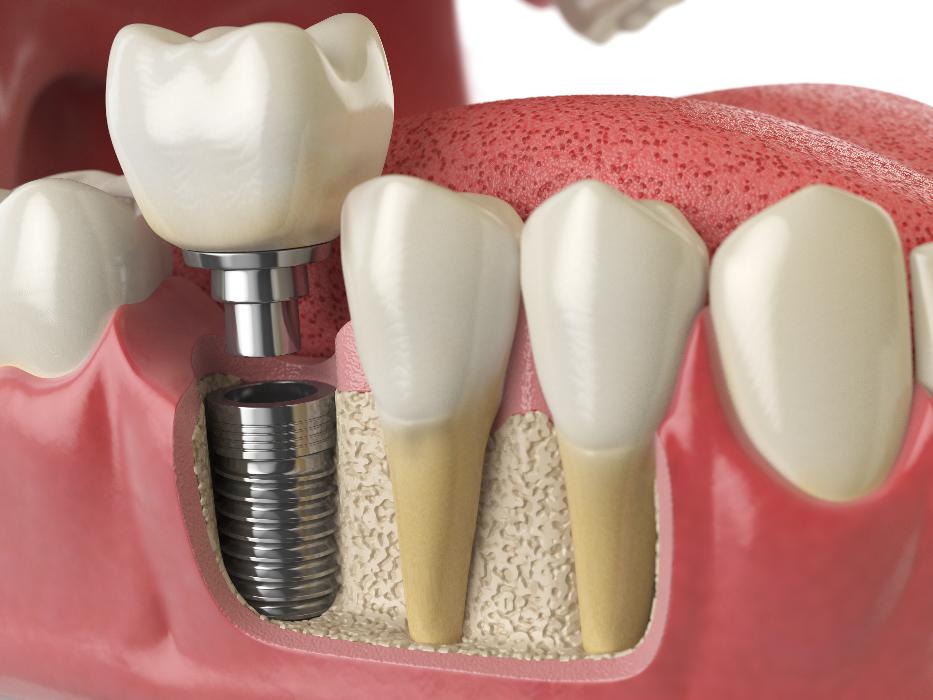Diagram showing how dental implants work, Roseville NSW