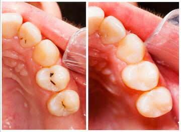 Real life composite filings, Roseville NSW