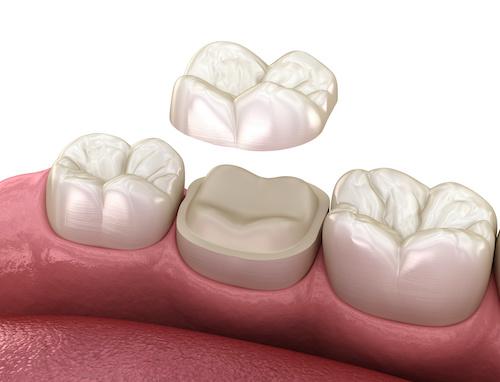 Diagram showing how dental inlays and onlays work on teeth, Roseville NSW