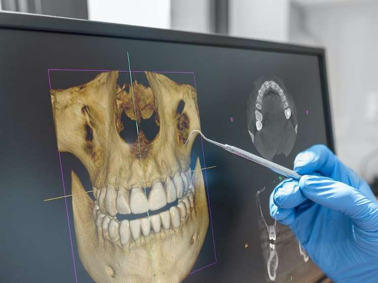 Person with dentist tool inspecting cone beam technology (CBCT), Roseville NSW