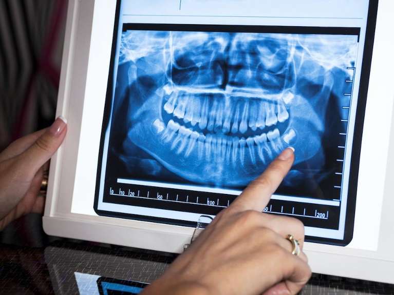 Woman pointing to a panoramic x-ray, Roseville NSW